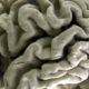 Photo of a brain section with Alzheimer's disease